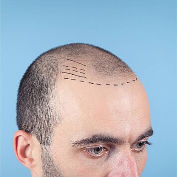 FUE_Haartransplantation__Dr._Schuhmann.jpg
