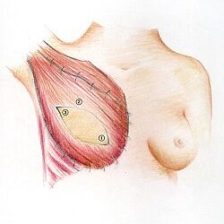 Brustrekonstruktion - Latissmus Dorsi Lappen Brustrekonstruktion mit dem Latissimus Dorsi Lappen, Dr. Karl Schuhmann