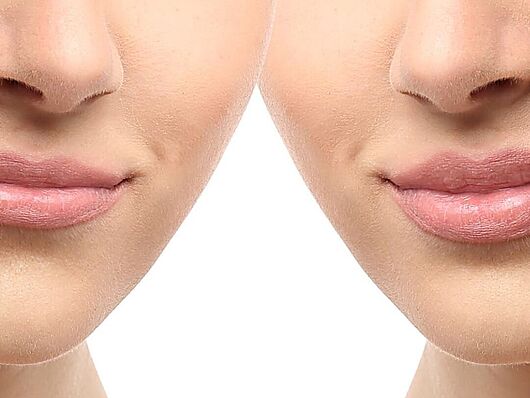 Zwei Frauengesichter links ohne Lippenkorrektur, rechts mit Lippenkorrektur | Ausschnitt Mund und Nase |