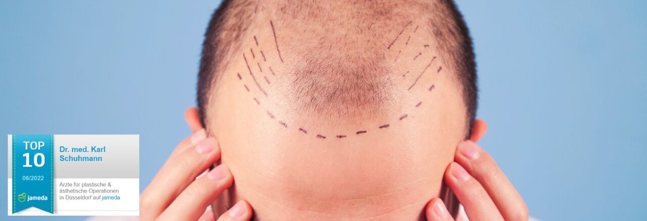Oberkopf eines Mannes mit OP Markierung für die Haartransplantation