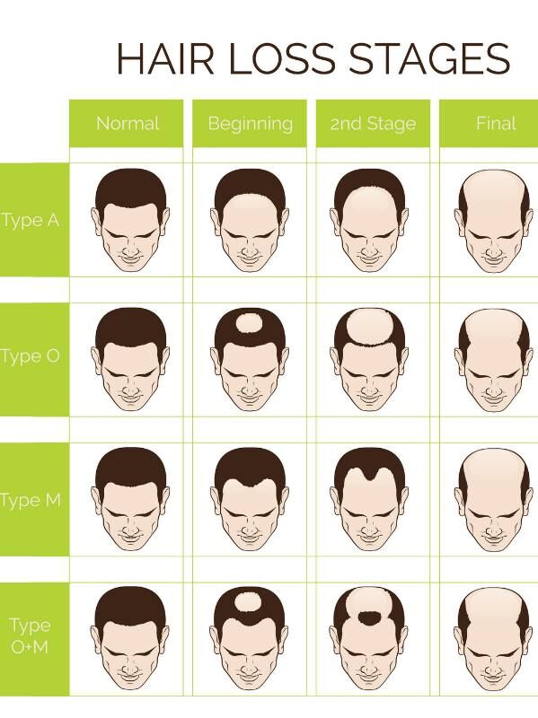 Grafik zu den Stadien des Haarverlustes