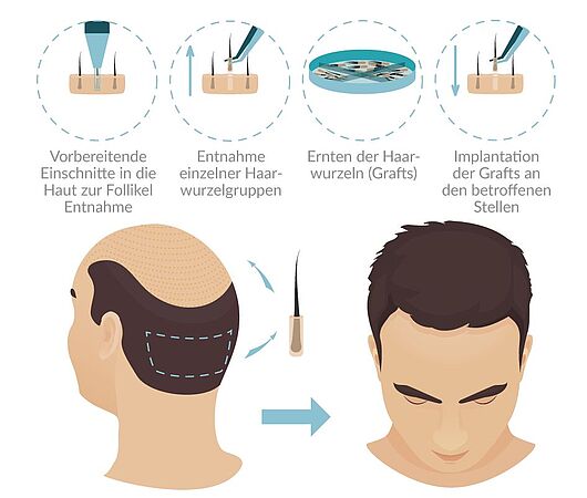 FUE Haartransplantation | Dr. Schuhmann Düsseldorf