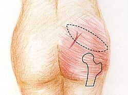 Brustrekonstruktion - SGAP Lappen Brustrekonstruktion mit dem SGAP Lappen, Dr. Karl Schuhmann