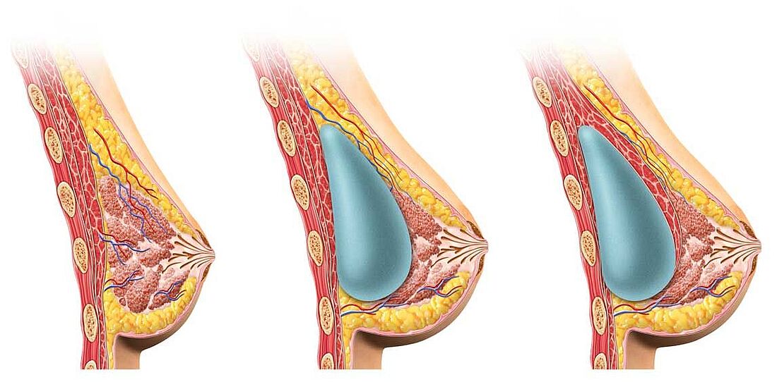 Brustvergrößerung Implantate | Düsseldorf | Bochum | Dr. Schuhmann Grafische Darstellung Brustvergrößerung, Lage der Brustimplantate