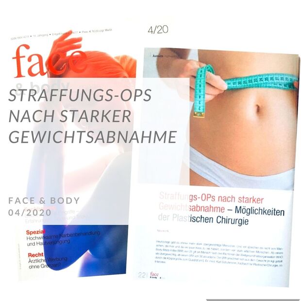 Straffungs-OP nach Gewichtsabnahme, Dr. Schuhmann