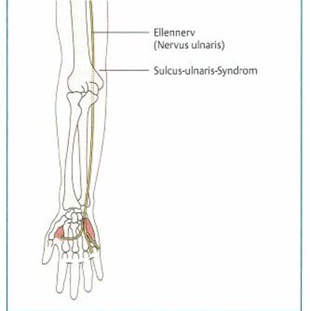 Behandlung Ulnarisrinnensyndrom | Handchirurg Dr. Karl Schuhmann