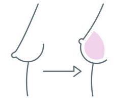 Bruststraffung Implantat | Dr. Schuhmann Düsselldorf
