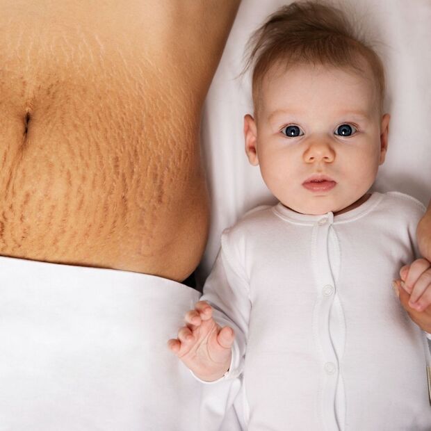 Bauch mit Dehnungsstreifen. Baby in weißem Strampler.